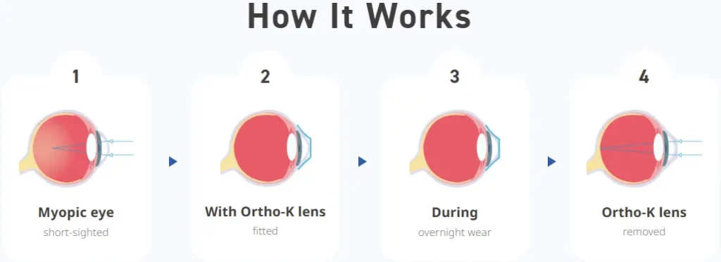 Ortho K Lenses Bedok Mall