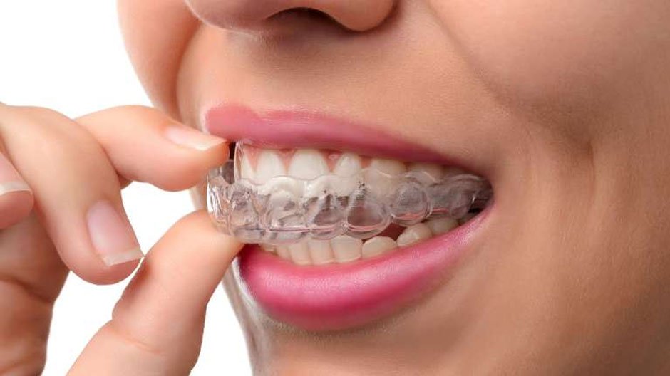 Invisalign vs. Traditional Braces