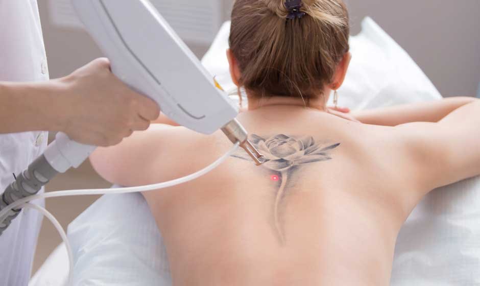 Should You Remove a Tattoo
