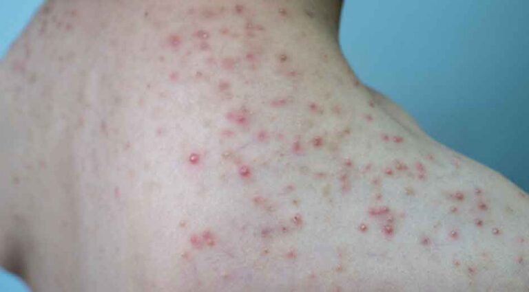 Shoulder Acne: Causes, Treatments, and Prevention Tips
