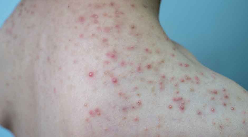Whole-Body Fungal Acne: Expert Guide to Treatment on Back, Chest, Shoulders, and Face
